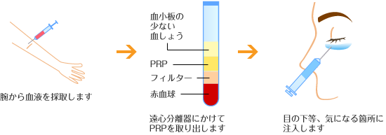 PRPとは